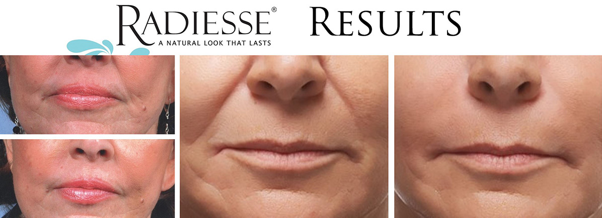coastal-valley-dermatology-carmel-radiesse-volume-injectable