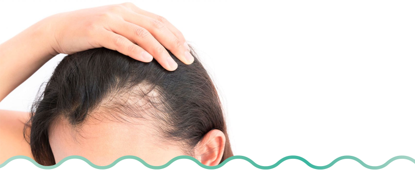 alopecia